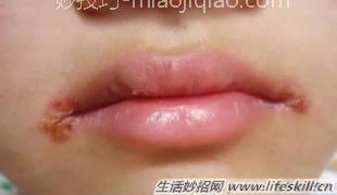 风油精另类小妙用 