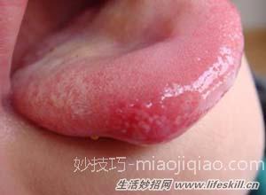 口腔溃疡老不好，三招来应对 
