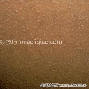 脸上长的痘痘、黑头，可以挤出来吗？