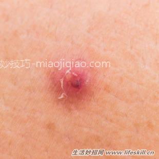 脸上长的痘痘、黑头，可以挤出来吗？