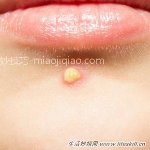 脸上长的痘痘、黑头，可以挤出来吗？